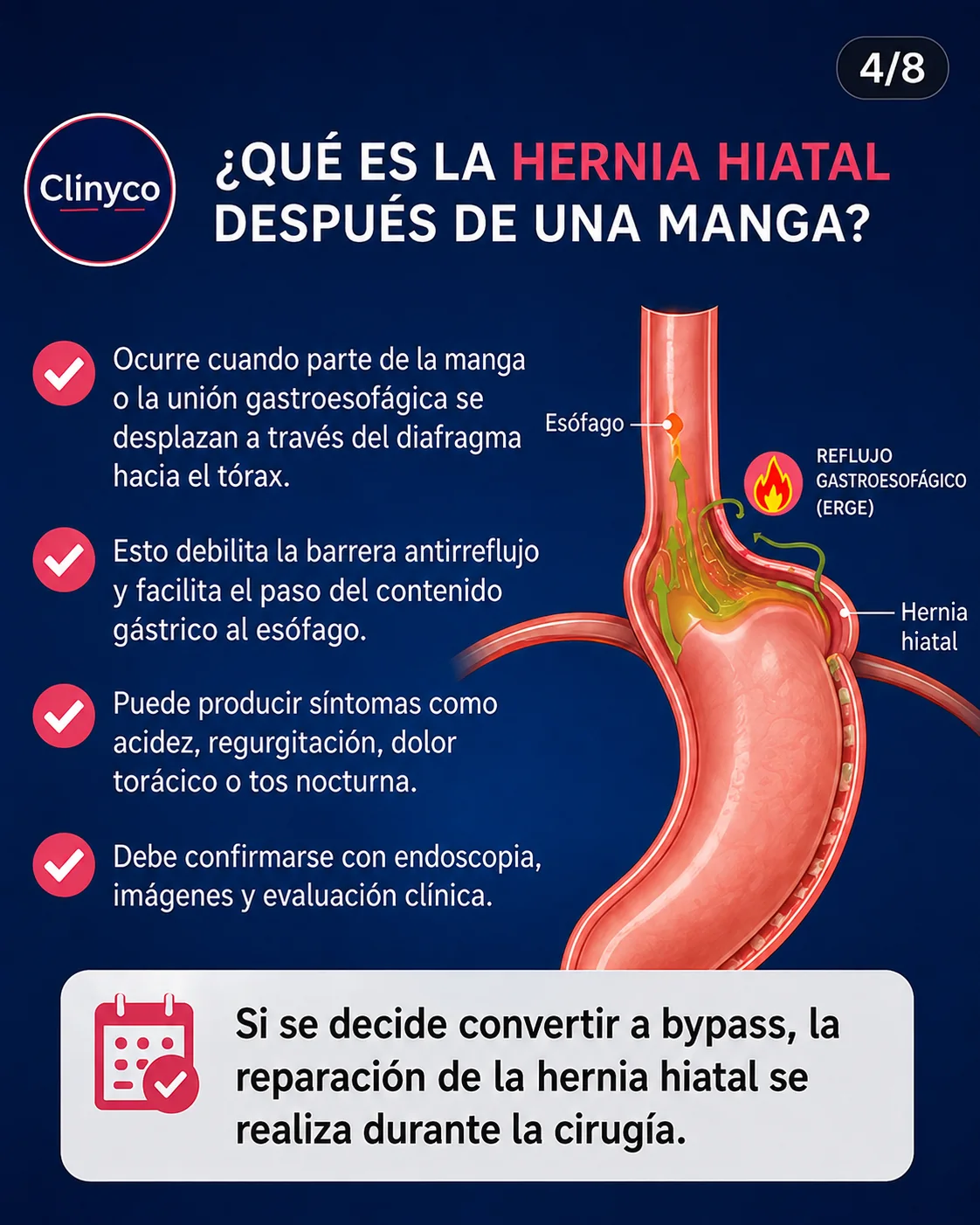 Hernia hiatal después de manga