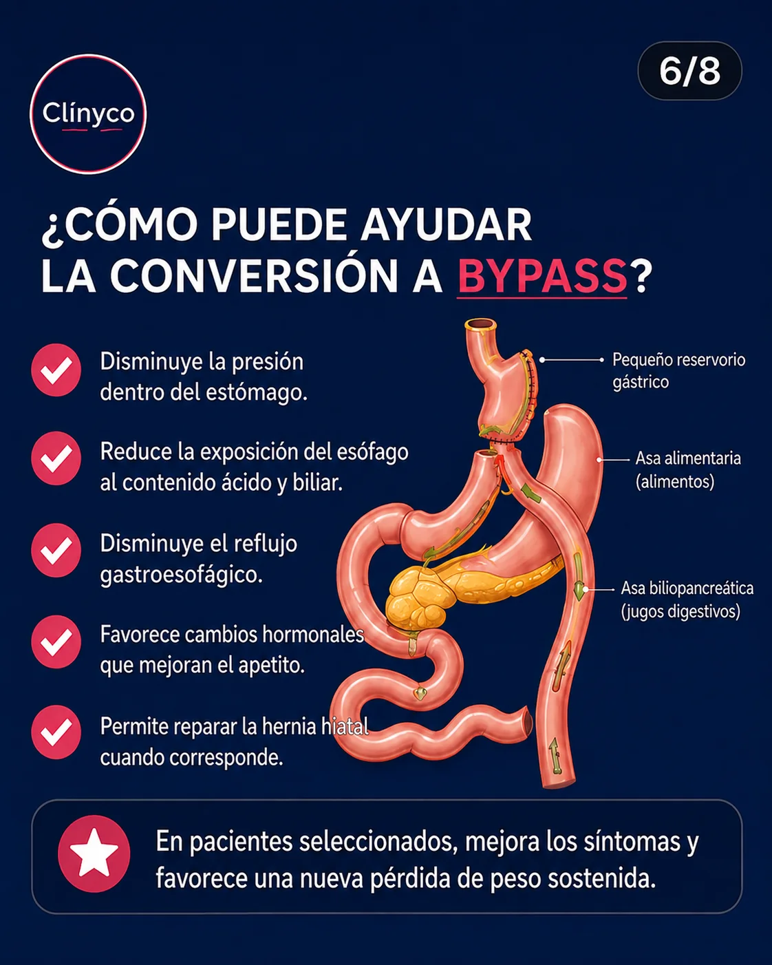 Conversión de manga a bypass